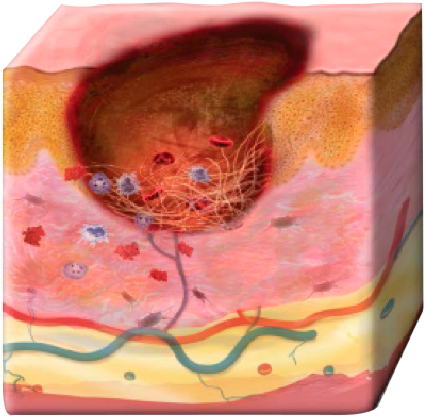 An illustrated cross-section of skin in a dysfunctional wound environment